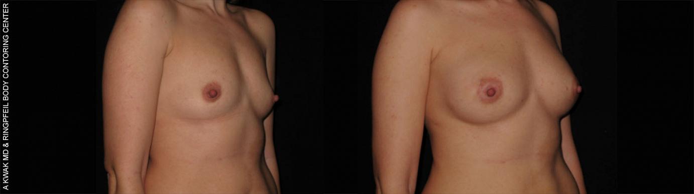 photos patient before and after Breast Augmentation