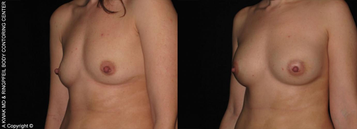 photos before and after Breast Augmentation