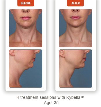 photos patient before and after Kybella treatment double chin