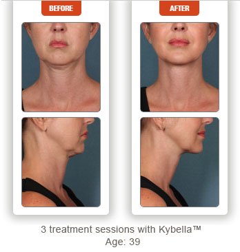 photos before and after kybella