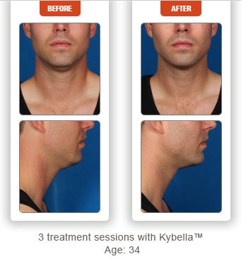 male patient before and after Kybella treatment double chin - photos