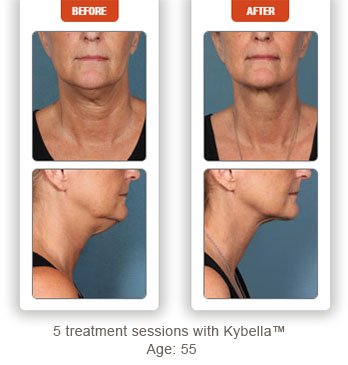 female patient before and after Kybella treatment double chin - photos