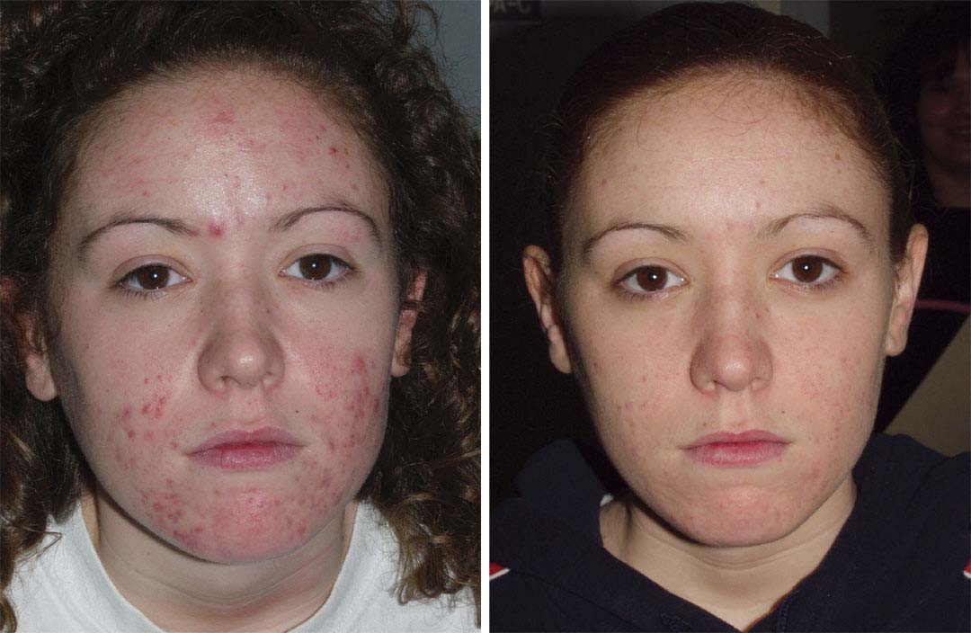 acne treatment with smoothbeam before and after