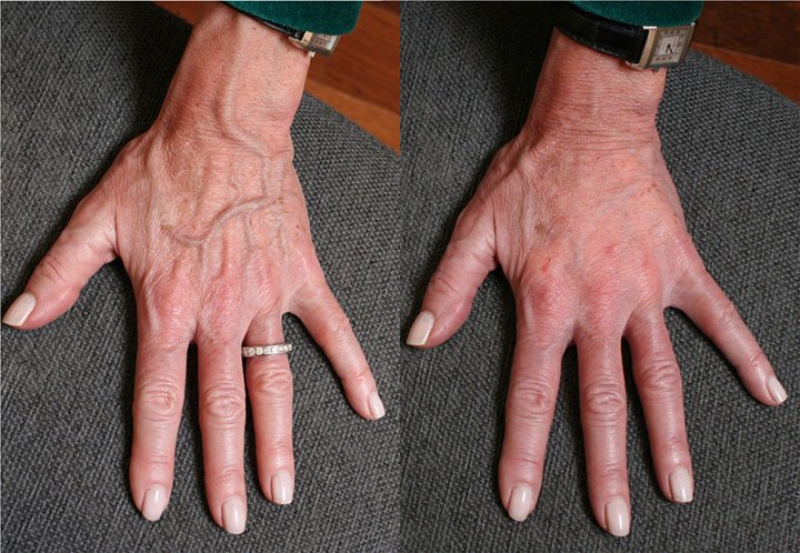 hands rejuvenation with filler before and after