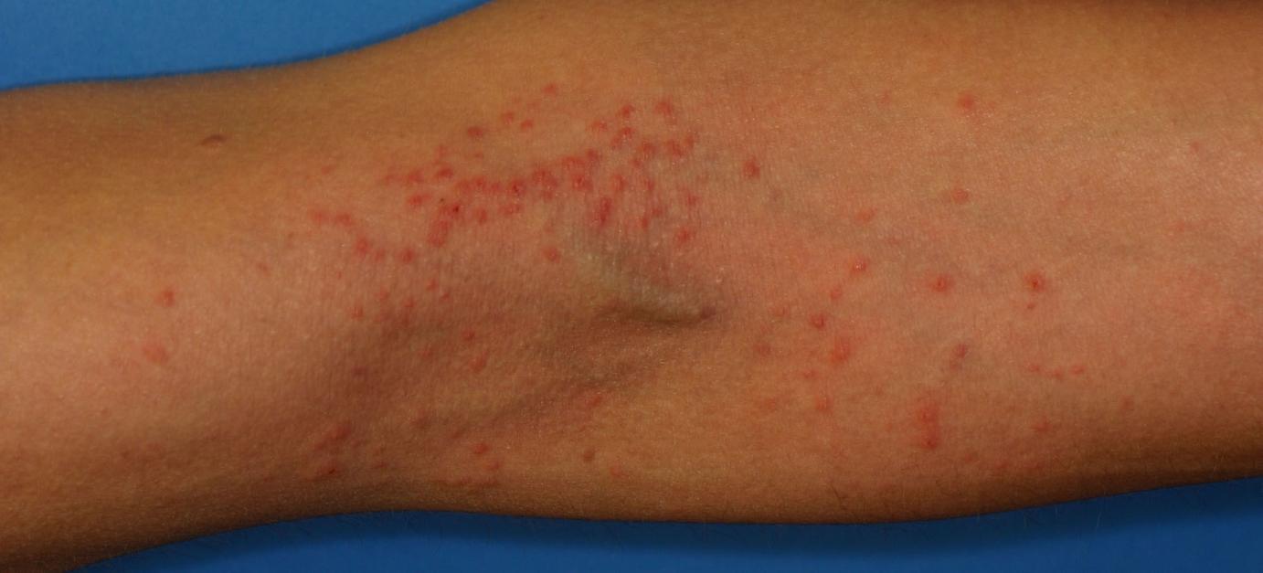 Philadelphia Eczema (Atopic Dermatitis) Treatment Main ...