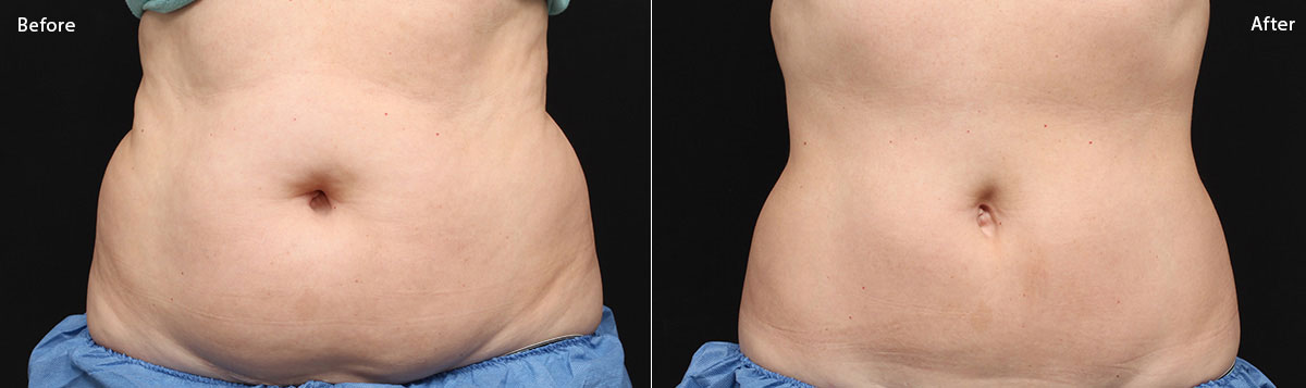 CoolSculpting: Reshape Your Body without Surgery - Bachelor, Eric