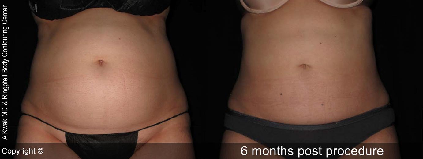 Liposuction In Philadelphia Dermatology And Fat Reduction Smartlipo Mainline