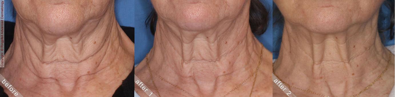 Philadelphia Neck Tightening  Before & After Pictures