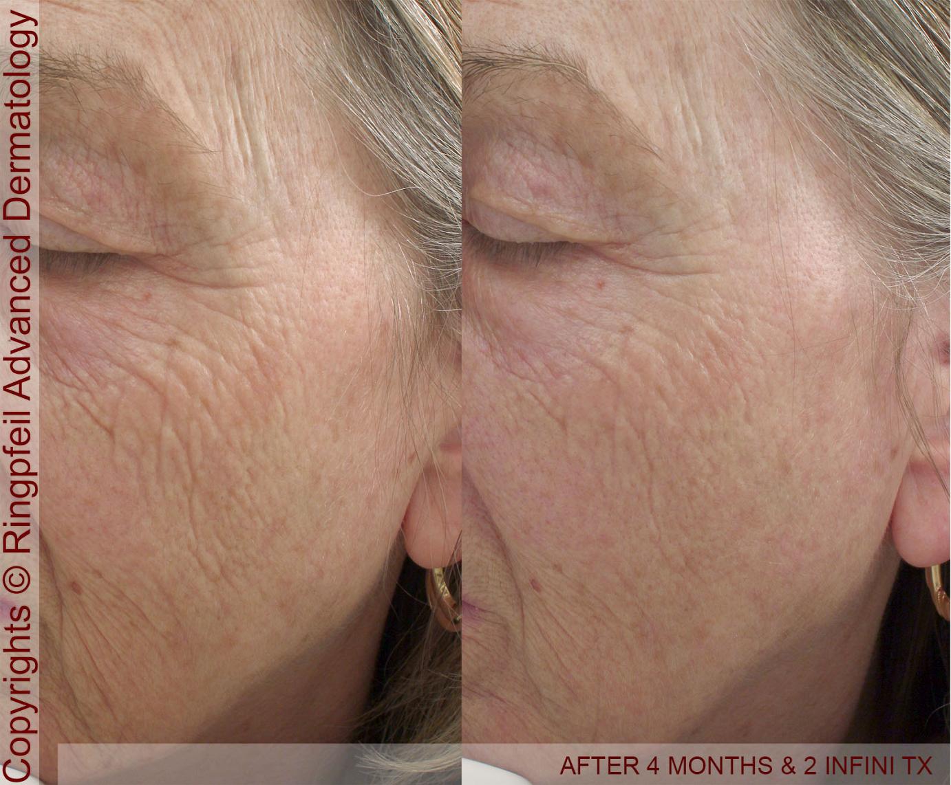 Skin Tightening Laser Treatments