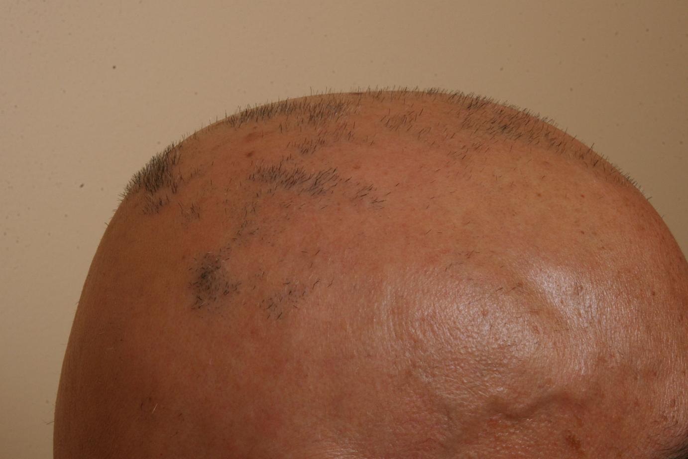 Lab creating 'cure' for baldness using cell cloning process