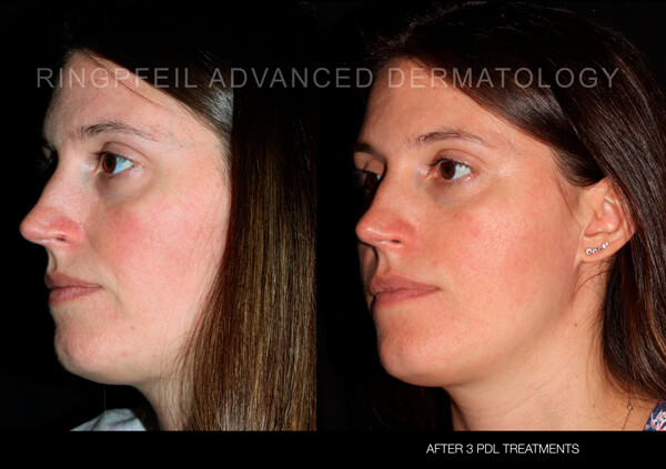 rosacea treatment before and after 2