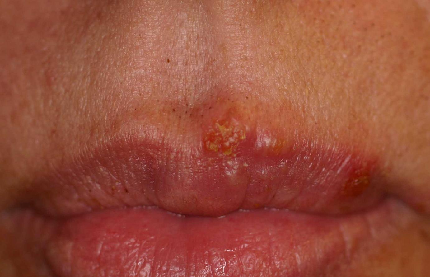 herpes 2 in the mouth