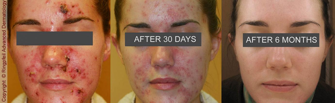 Philadelphia Acne Treatment Before & After Pictures