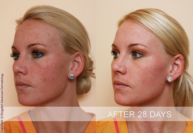 photos patient before and after treatments brown spots