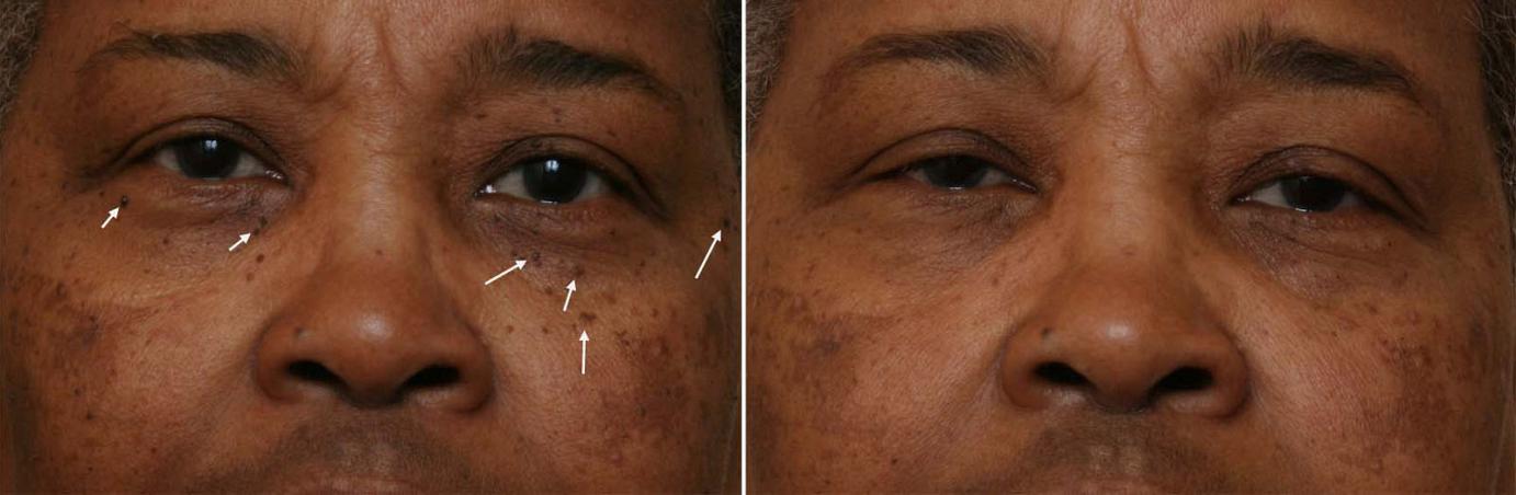 African American and Ethnic Skin Dermatology - Black ...