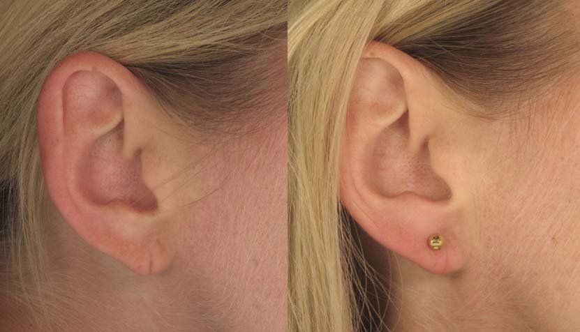earlobe repair before and after