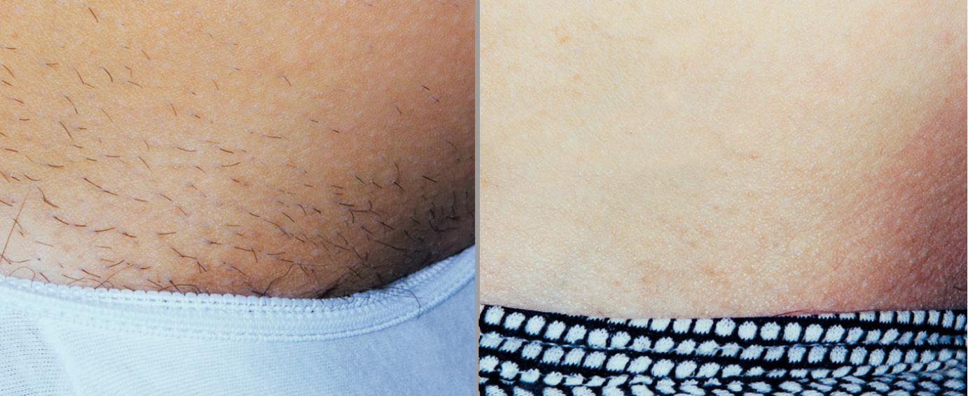 laser hair removal underarm before and after