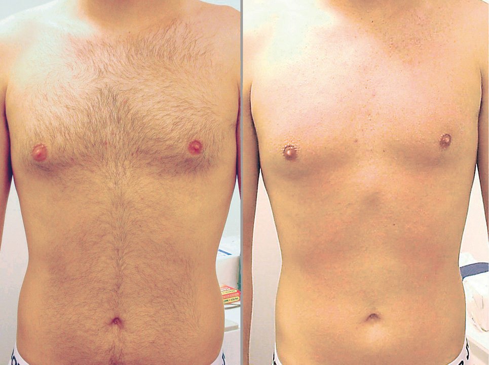 laser hair removal for men before and after