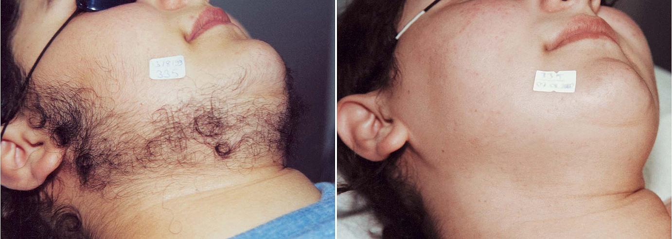 https://www.ringpfeildermatology.com/images/internal/hr/laser-facial-hair-removal-before-after.jpg