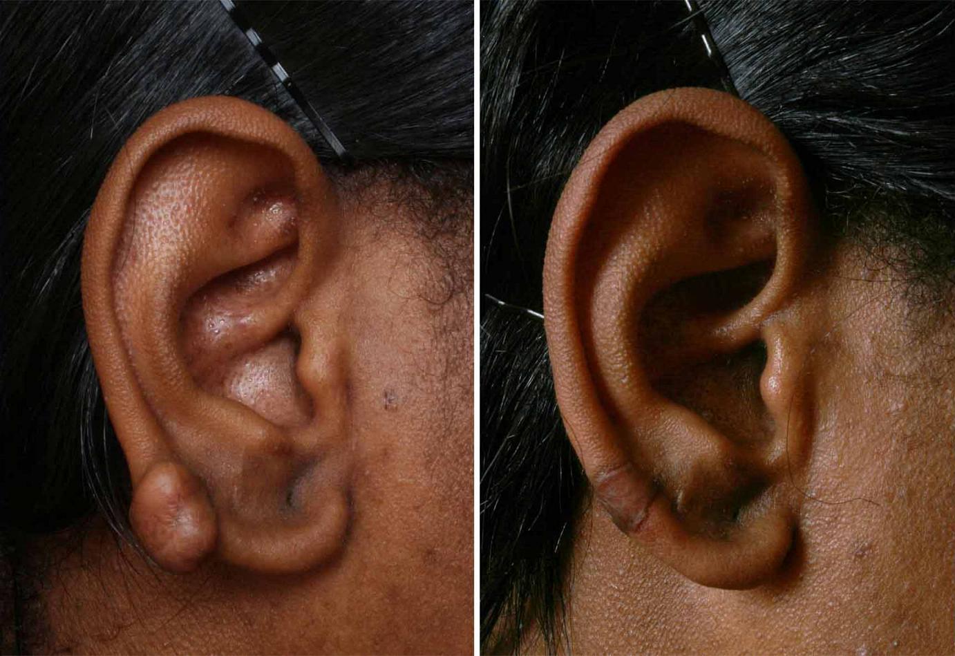 Earlobe Repair, Keloids on Ears