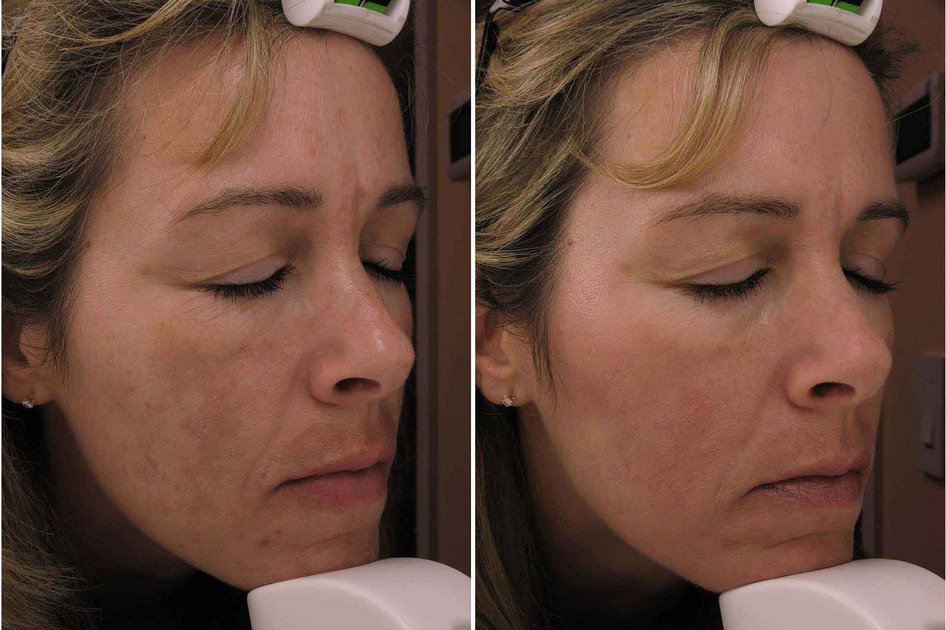 Brown Spots And Melasma Treatments