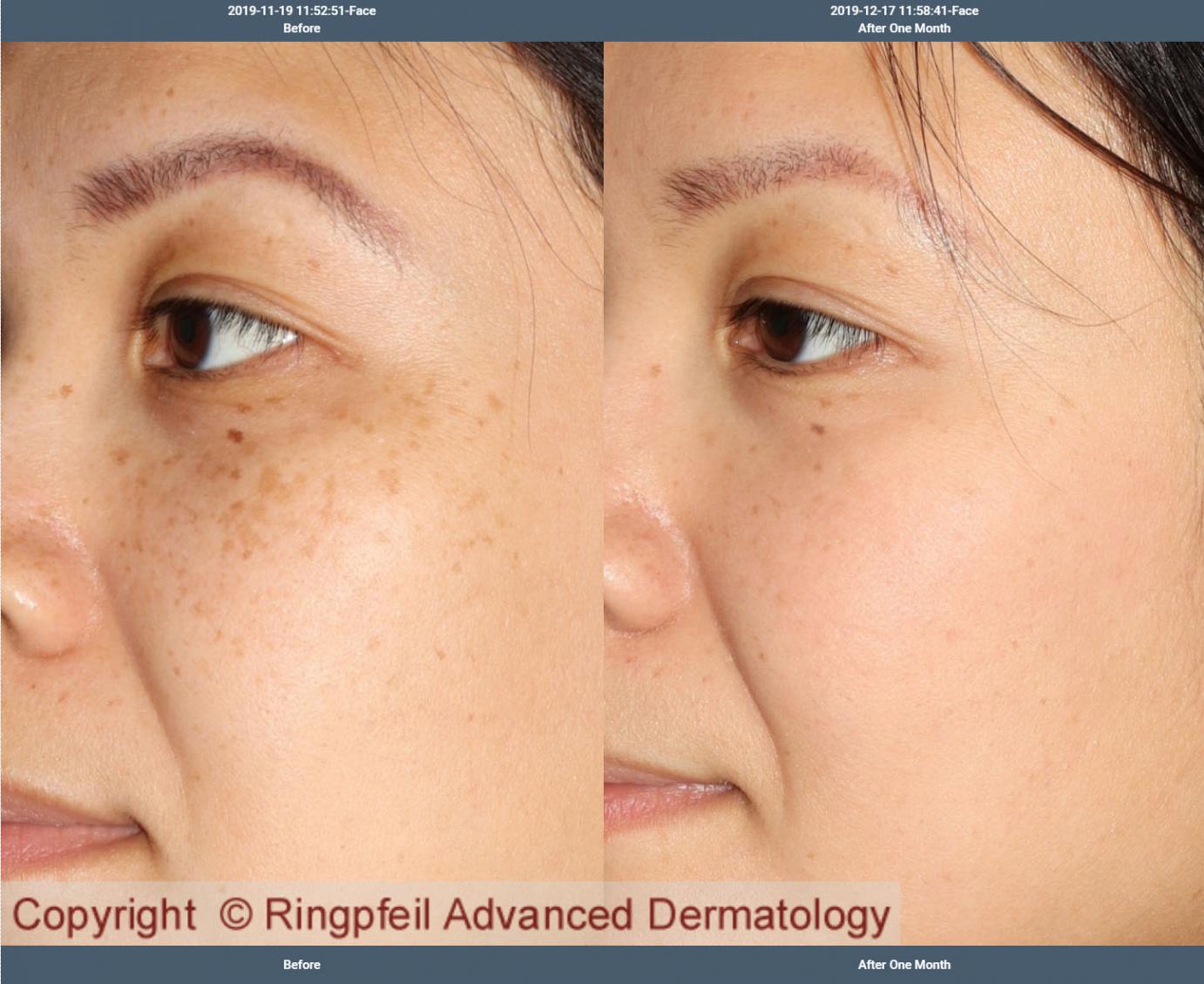 Melasma treatment before and after 1Mo