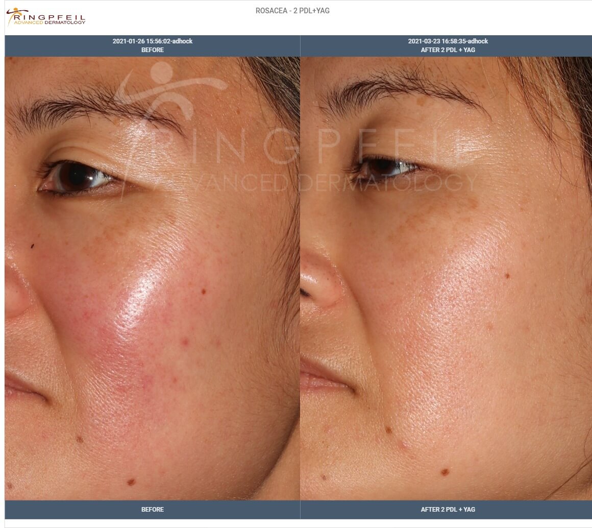 rosacea cheeks treatment