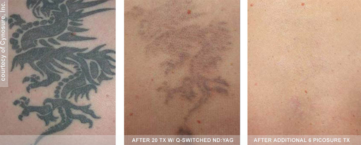 Best Laser Tattoo Removal with Picosure - Philadelphia ...