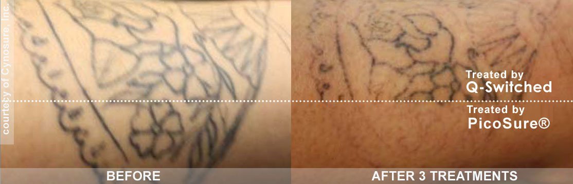 tattoo keloid laser treatment