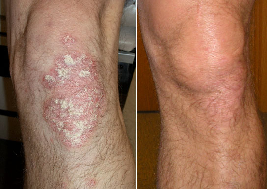 psoriasis treatment before and after