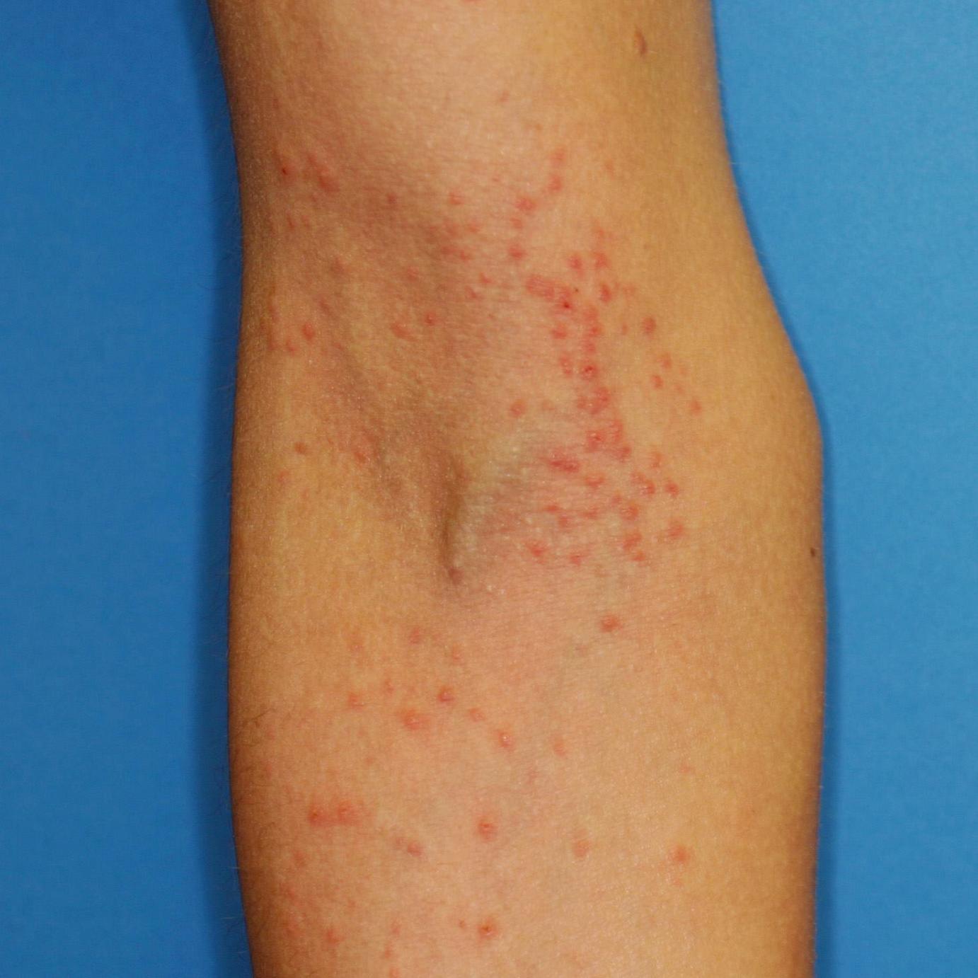 Rash On The Side Of My Thigh At Clara Johnson Blog